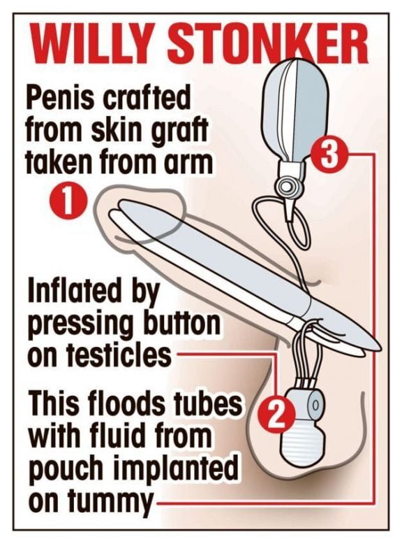 penis bionic 2